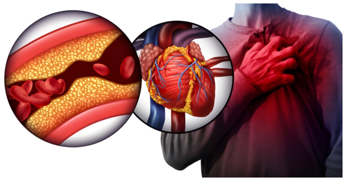 ঘরে বসেই বুঝবেন হার্ট ব্লকেজের সাধারণ লক্ষণগুলো। ছবি: আয়ুস্মান হসপিটাল